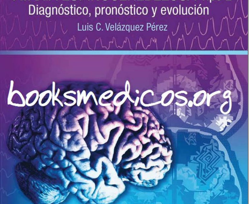 Ataxia Espinocerebelosa Tipo 2